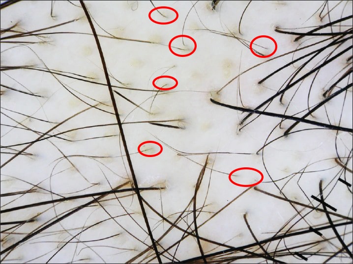 trichogram - detail vyrůstajících vlasů z pokožky na místě vypadávání. Zakroužkované jsou jemné vlasy.