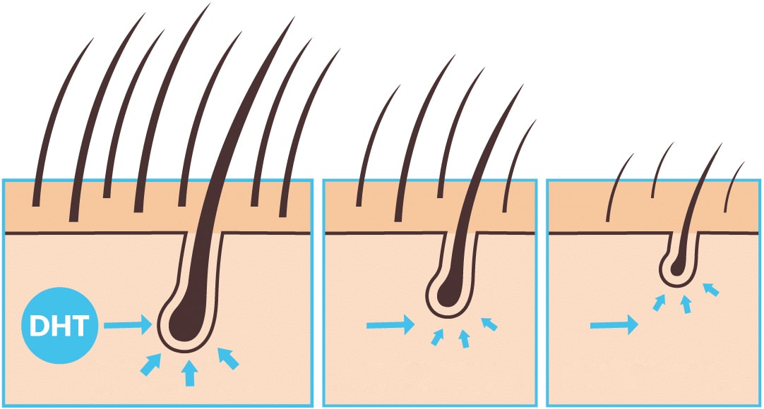 DHT svým působením zmenšuje vlasové kořínky