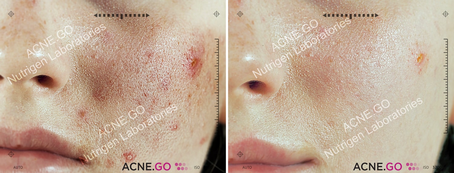 Acne.Go tablety a krém fotky před a po