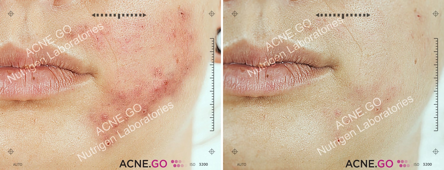 Acne.Go tablety a krém fotky před a po