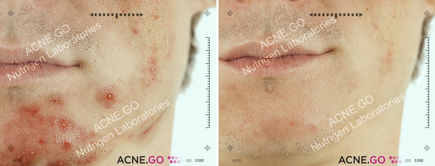 Acne.Go tablety a krém fotky před a po