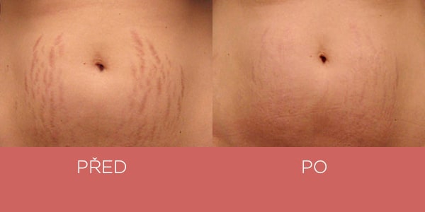 Fotky před a po - krém na strie - břicho