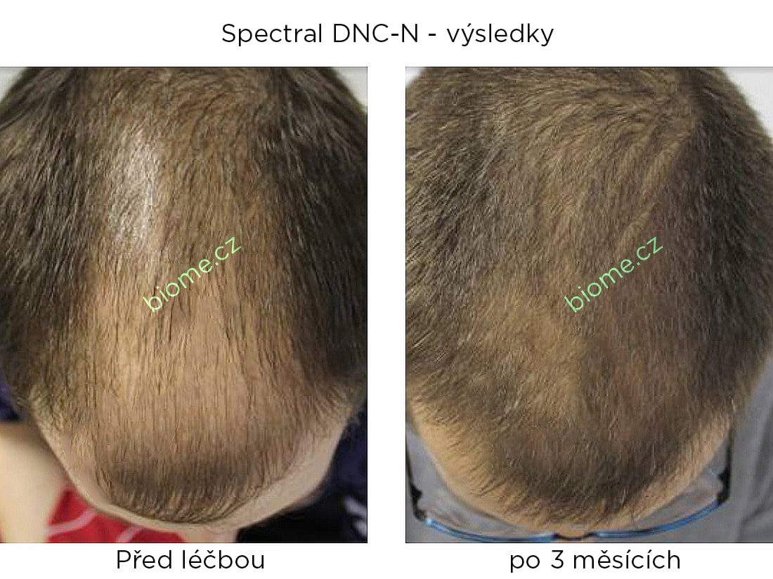 výsledky užívání produktu spectral DNCN s nanoxidilem u mužů po 3 měsících