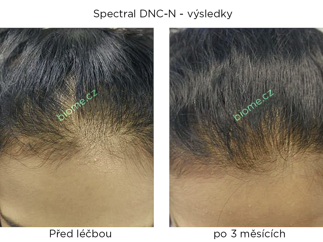 výsledky užívání produktu spectral DNCN s nanoxidilem u žen po 3 měsících