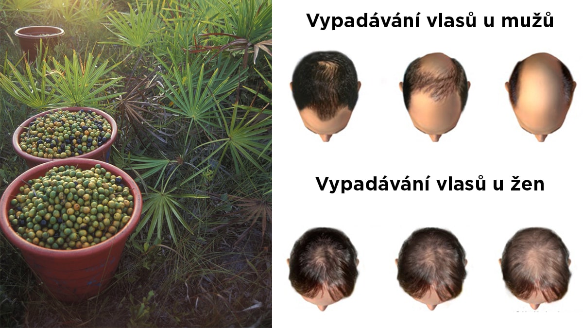 Saw palmetto natrhané bobule. průběh vypadávání vlasů u mužů a žen.