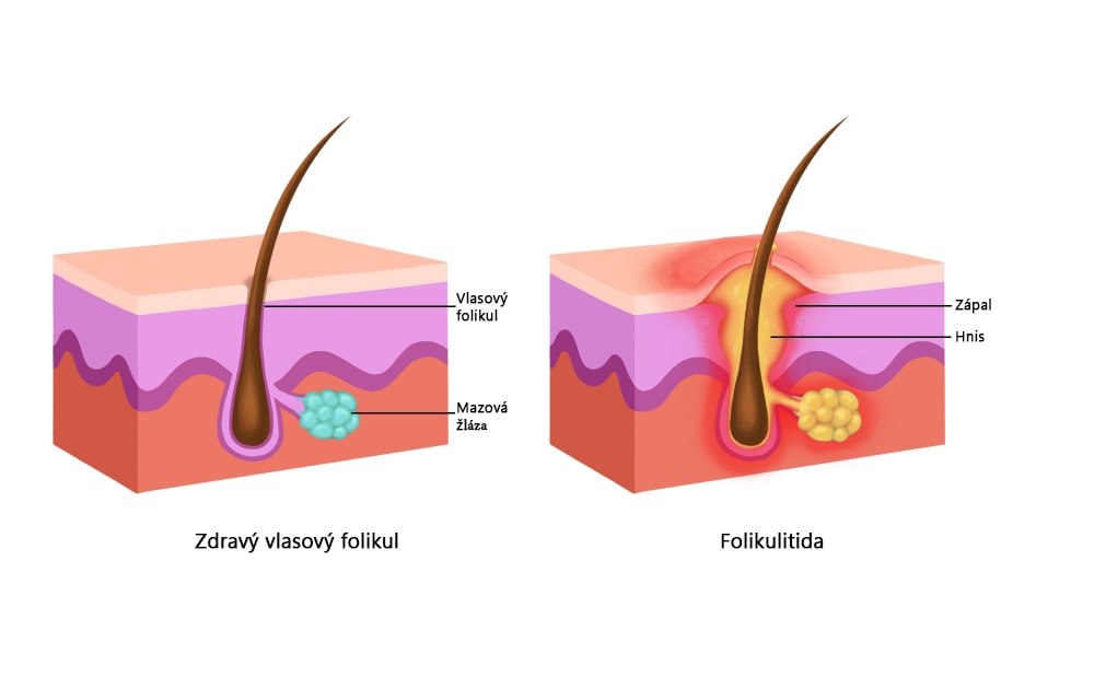 Porovnání zdravý folikul a folikul se zánětem